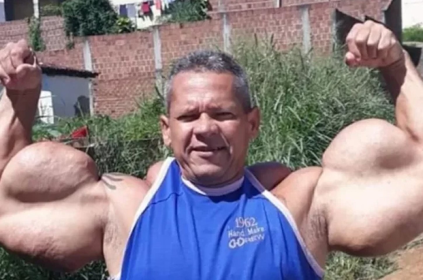 Morte do 'Popeye brasileiro' reacende alerta sobre riscos de anabolizantes
