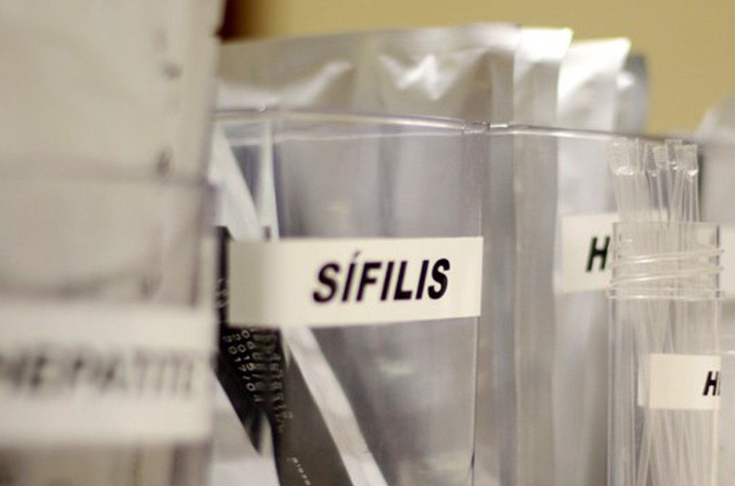 Sífilis avança no Brasil com mais de 800 mil casos em gestantes