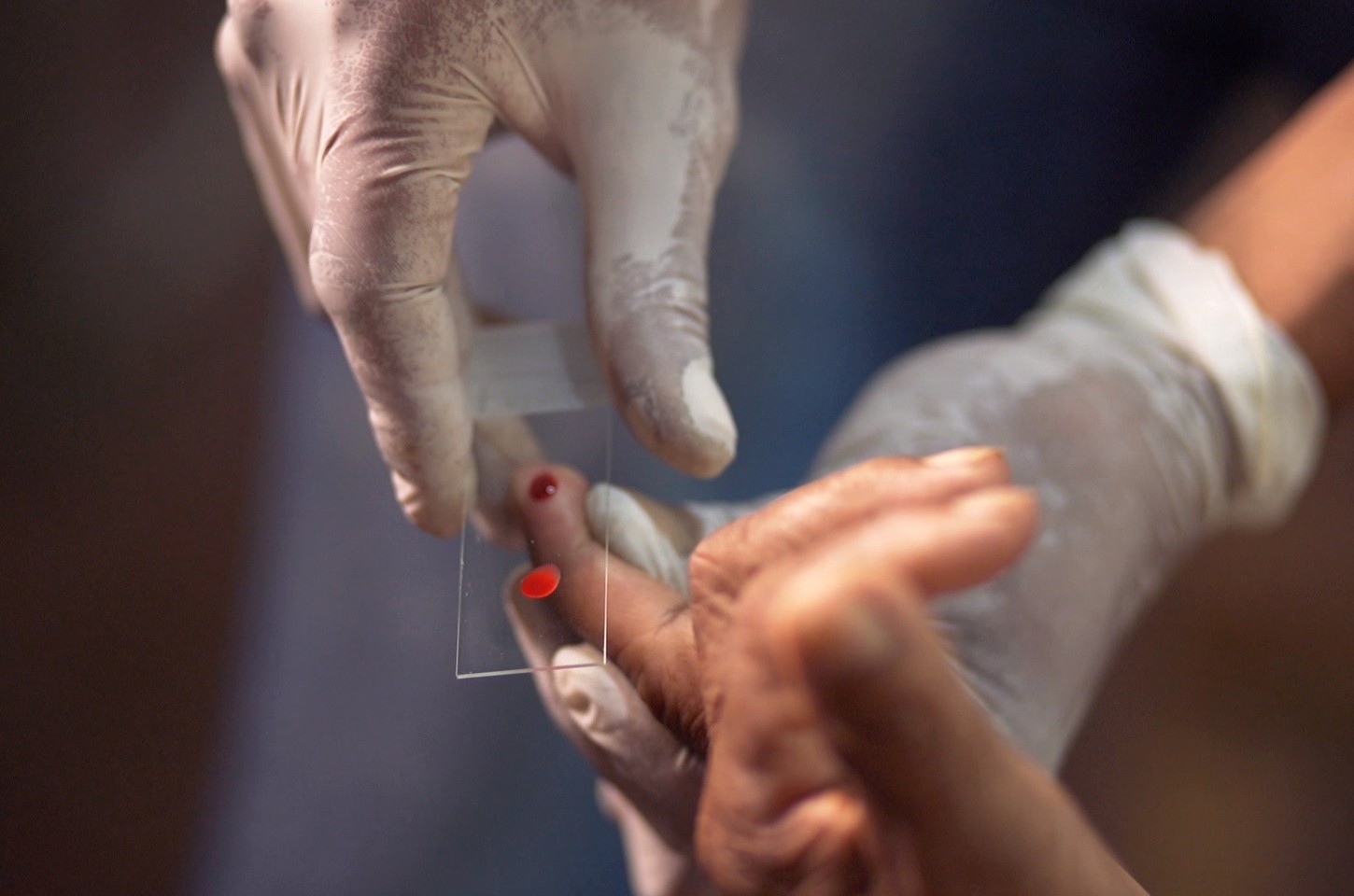 SUS inicia tratamento inédito contra malária para crianças